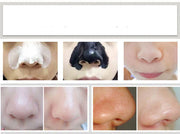 Triple Action Blackhead Control Skincare Kit